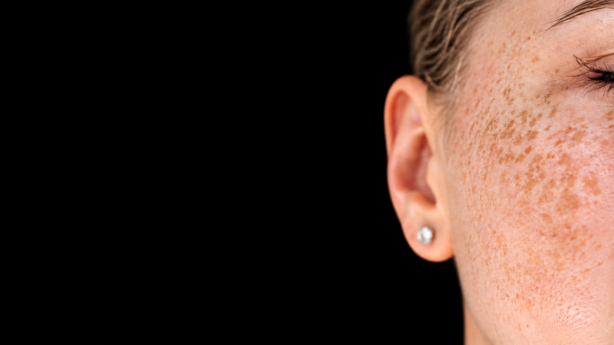 Skin Pigmentation