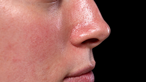 Anti-Aging & Sun Damage Program |  Catalyst Retinol Peel